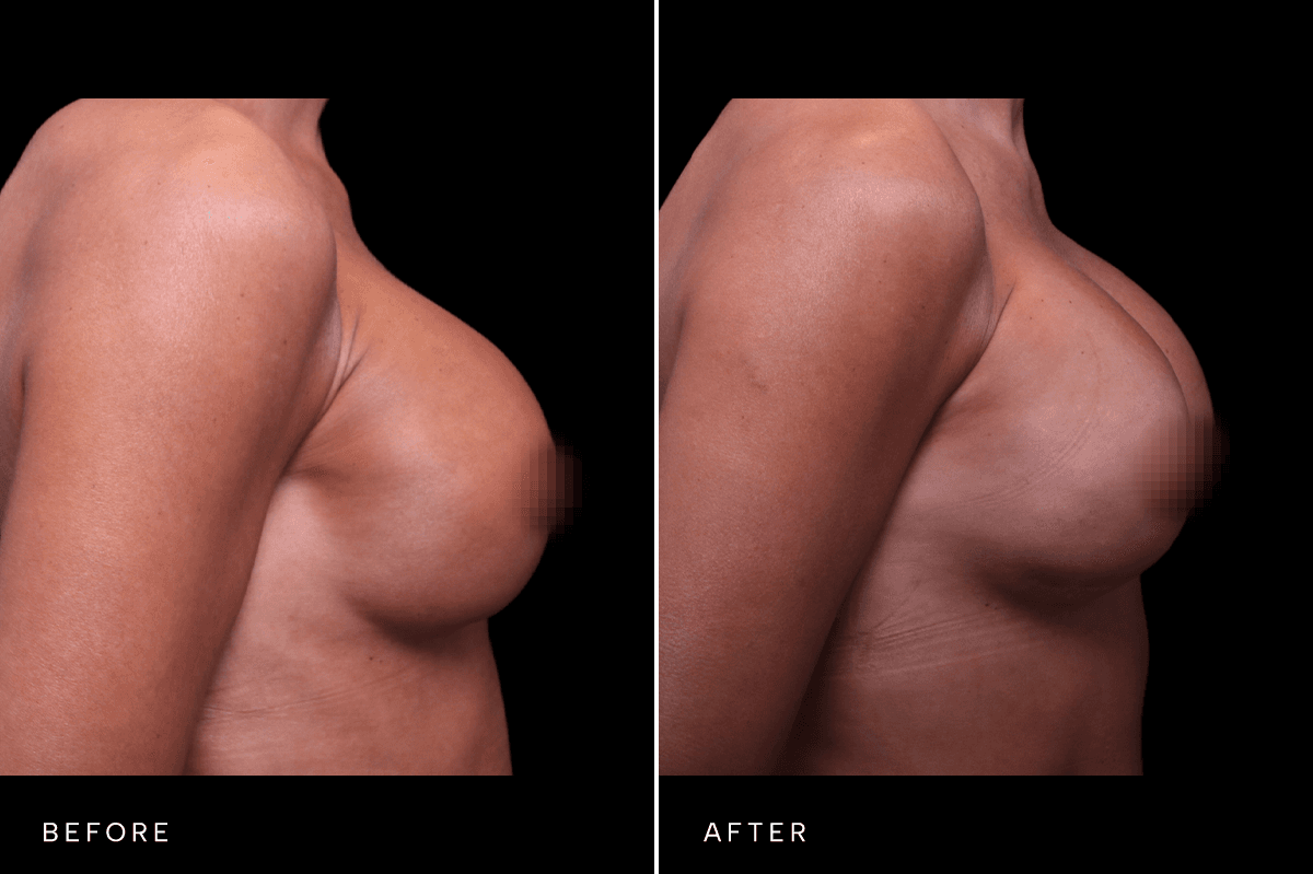 Omni Breast Gallery - BAM 9237 - B Side