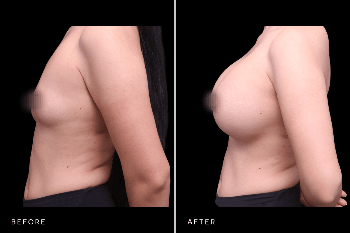 Omni Breast Gallery - BAM 4748 - B Side