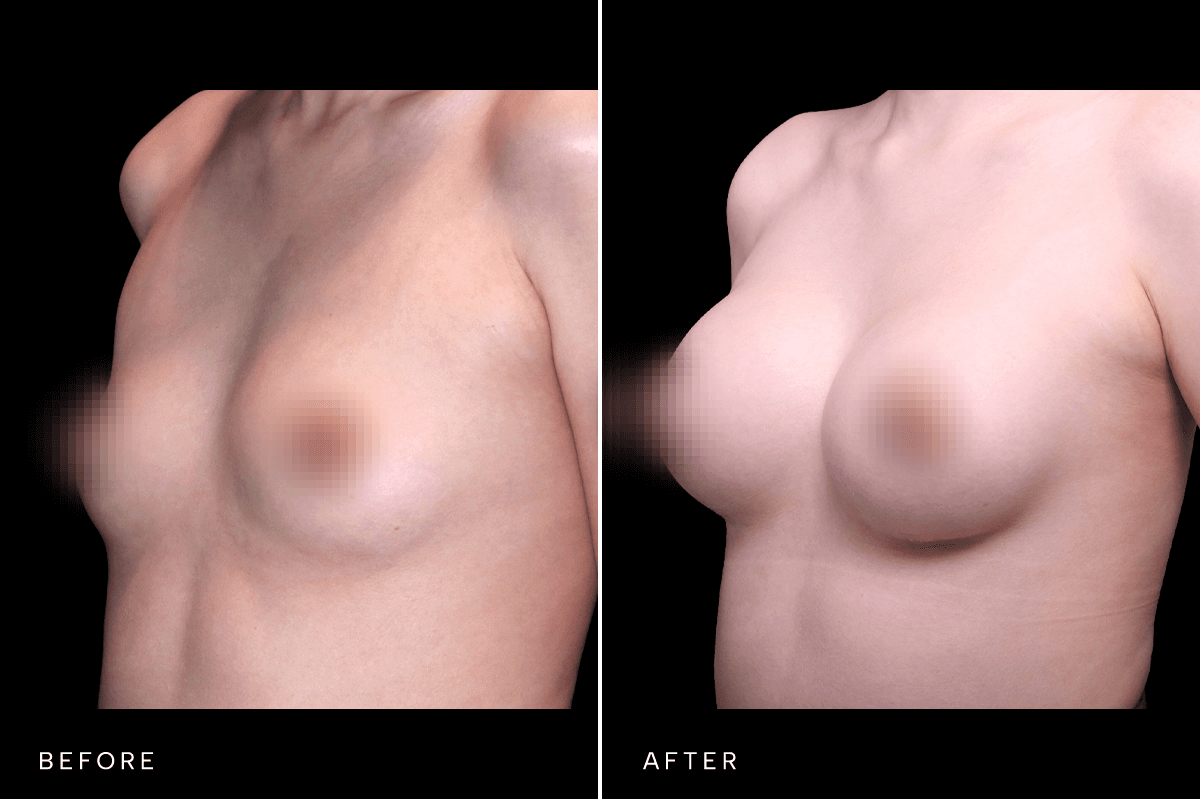 Omni Breast Gallery - BAM 6629 - B Angle