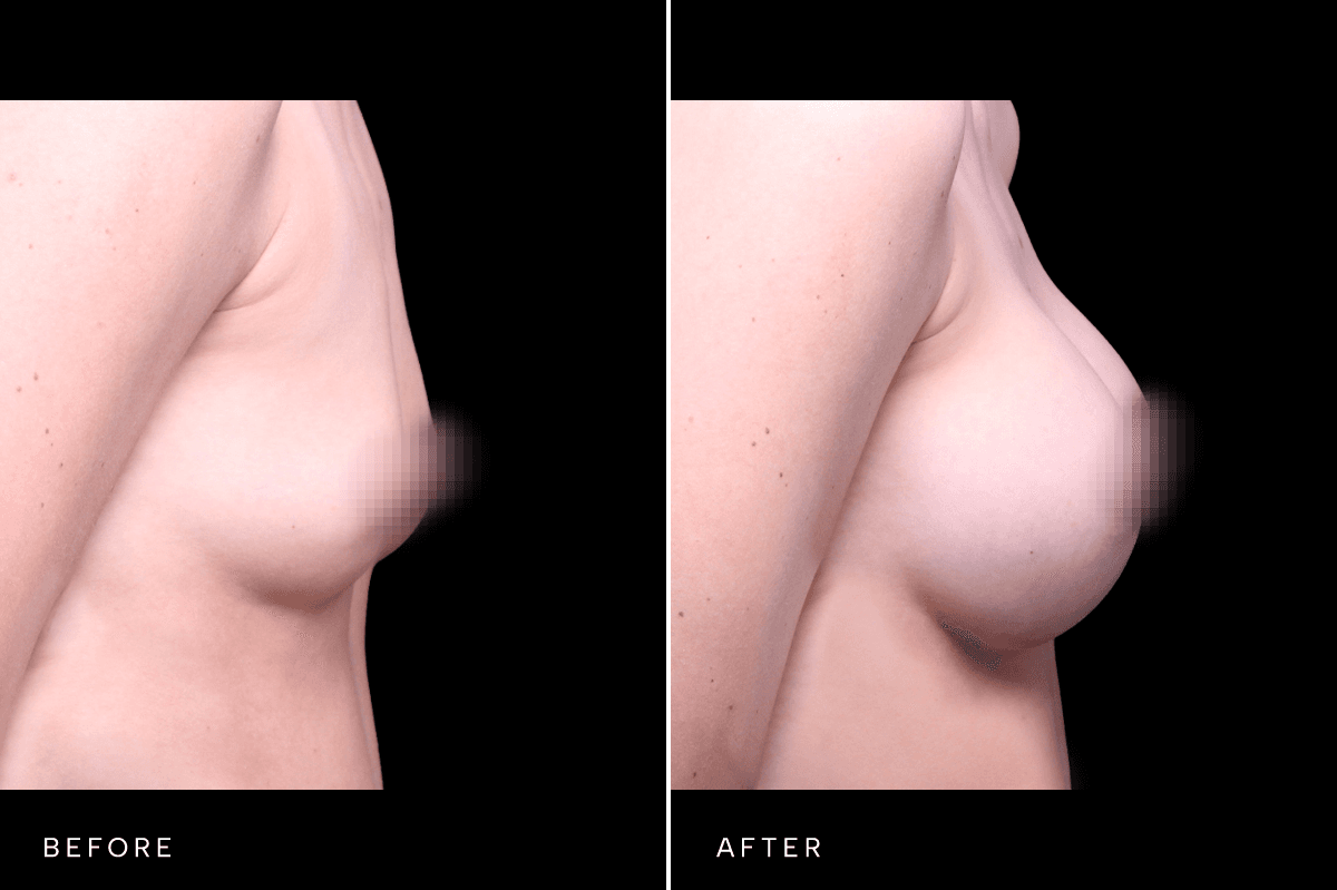 Omni Breast Gallery - BAM 6400 - C Side