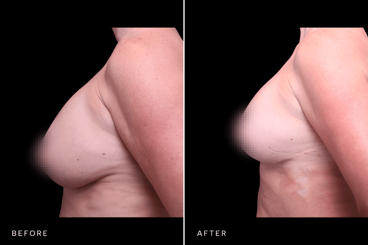 Omni Breast Gallery - MASTO BAM 5933 - B Side