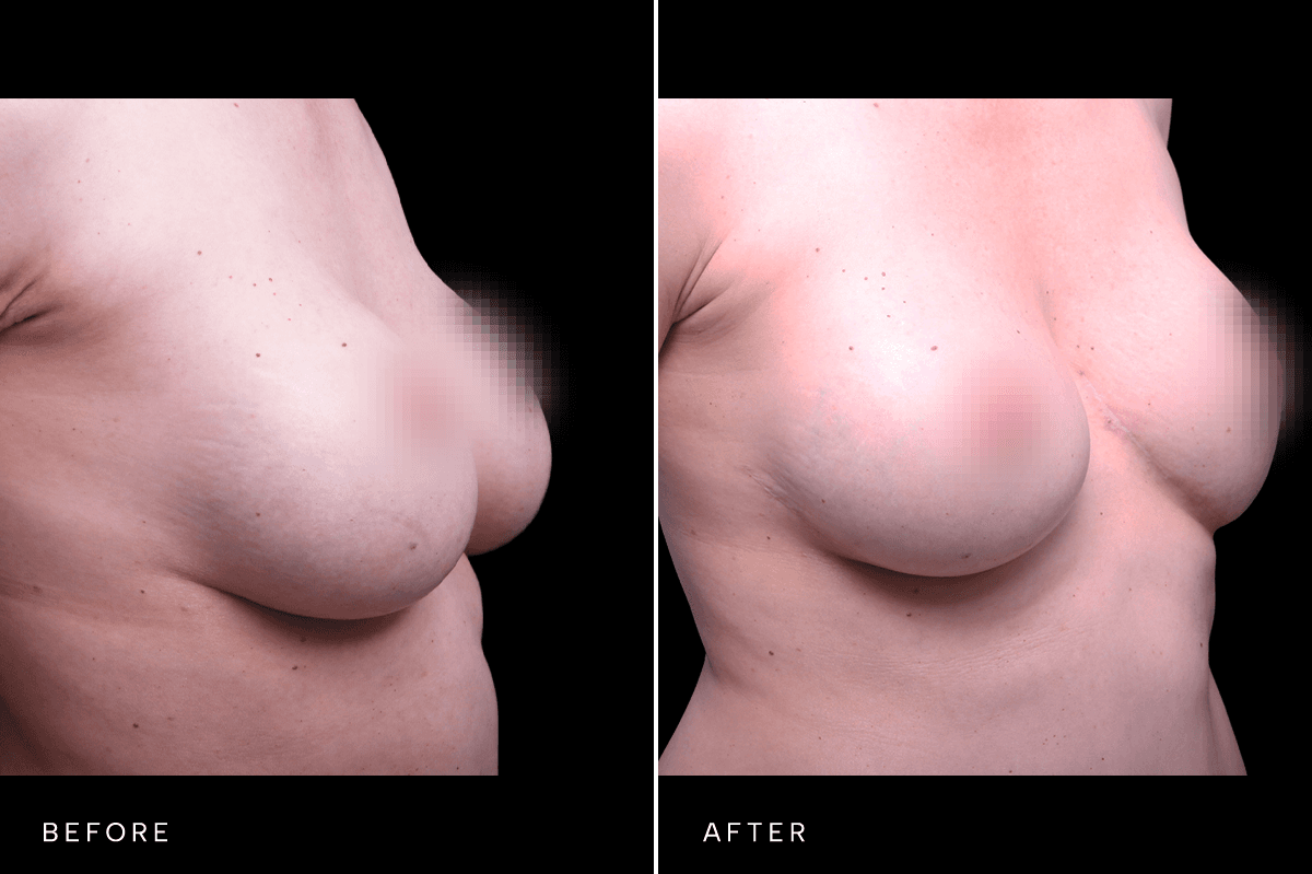 Omni Breast Gallery - MASTO 5977 - C Angle