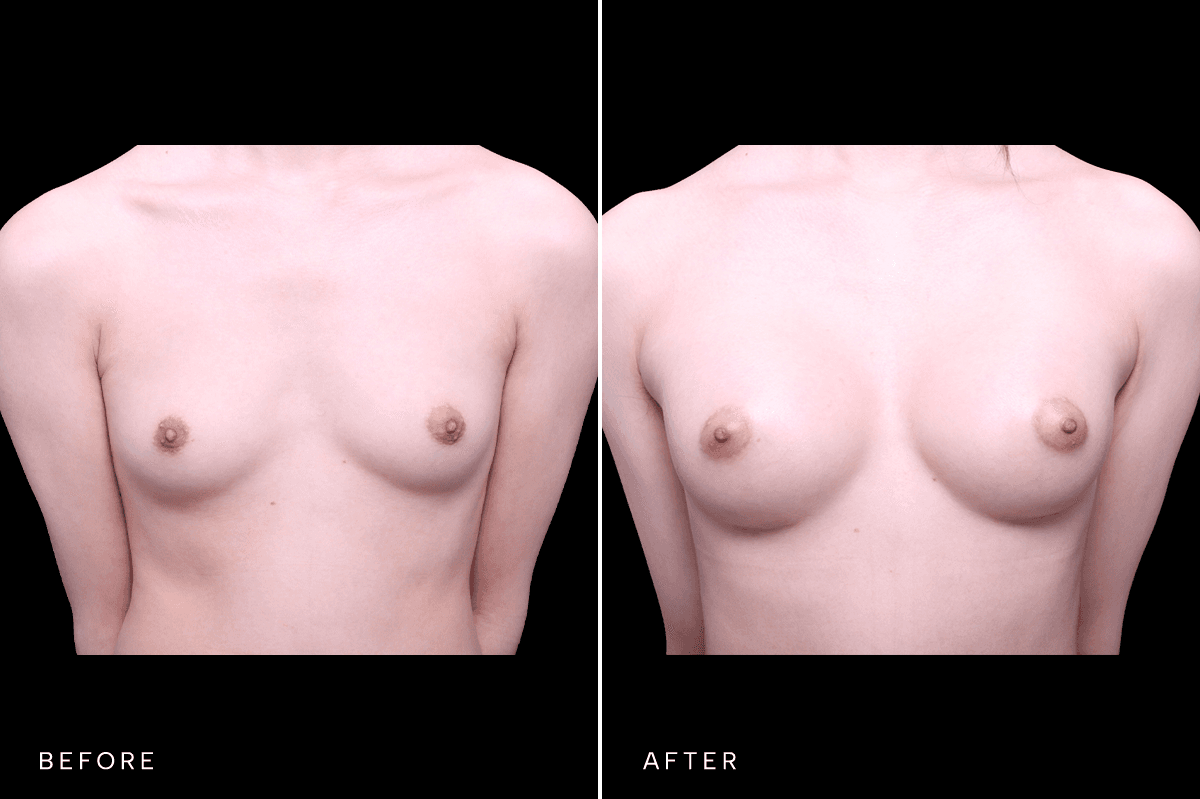 Omni Breast Gallery - BAM GC 6505 - A Front