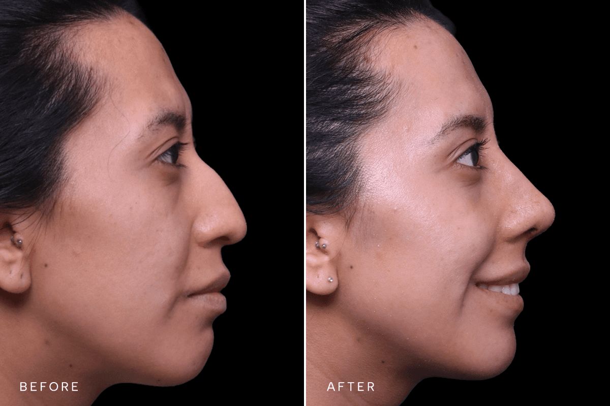 Omni Rhinoplasty Before and After — RHINO 5907 - B Side