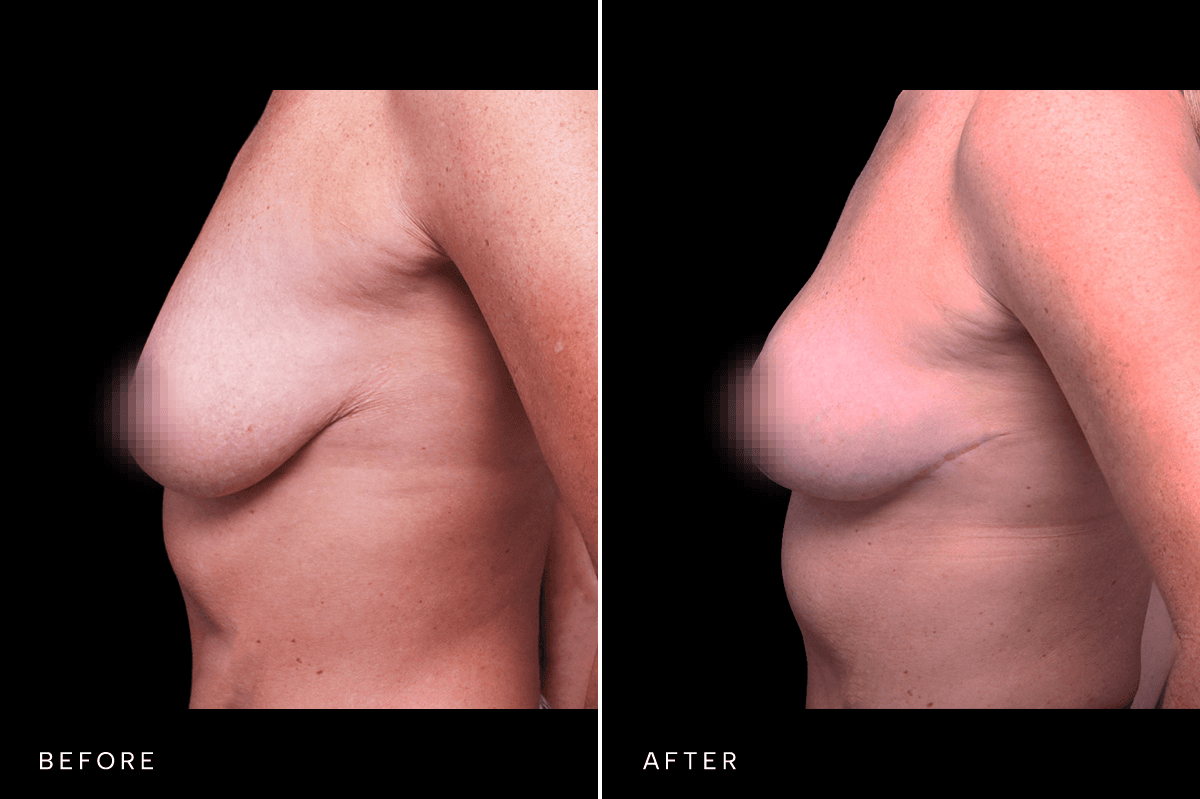 Omni Breast Gallery - MASTO FGI 6034 - C Angle
