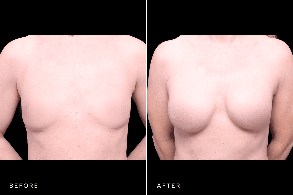 Omni Breast Gallery - BAM 9757 - A Front