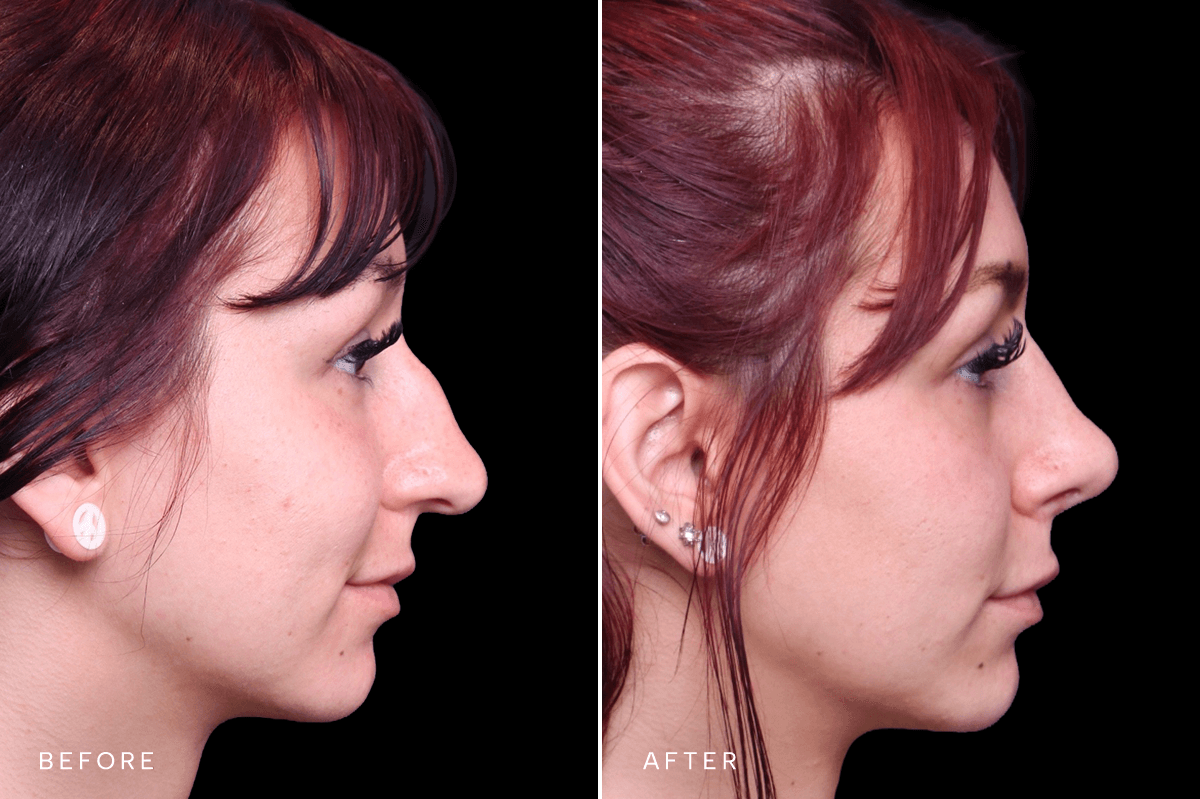 Omni Rhinoplasty Before and After — RHINO 6350 - B Side