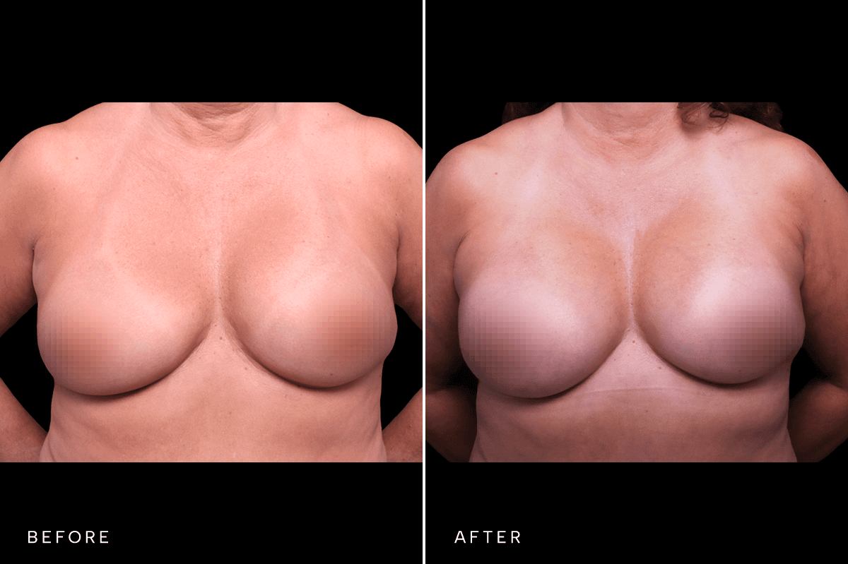 Omni Breast Gallery - BAM 17090 - A Front