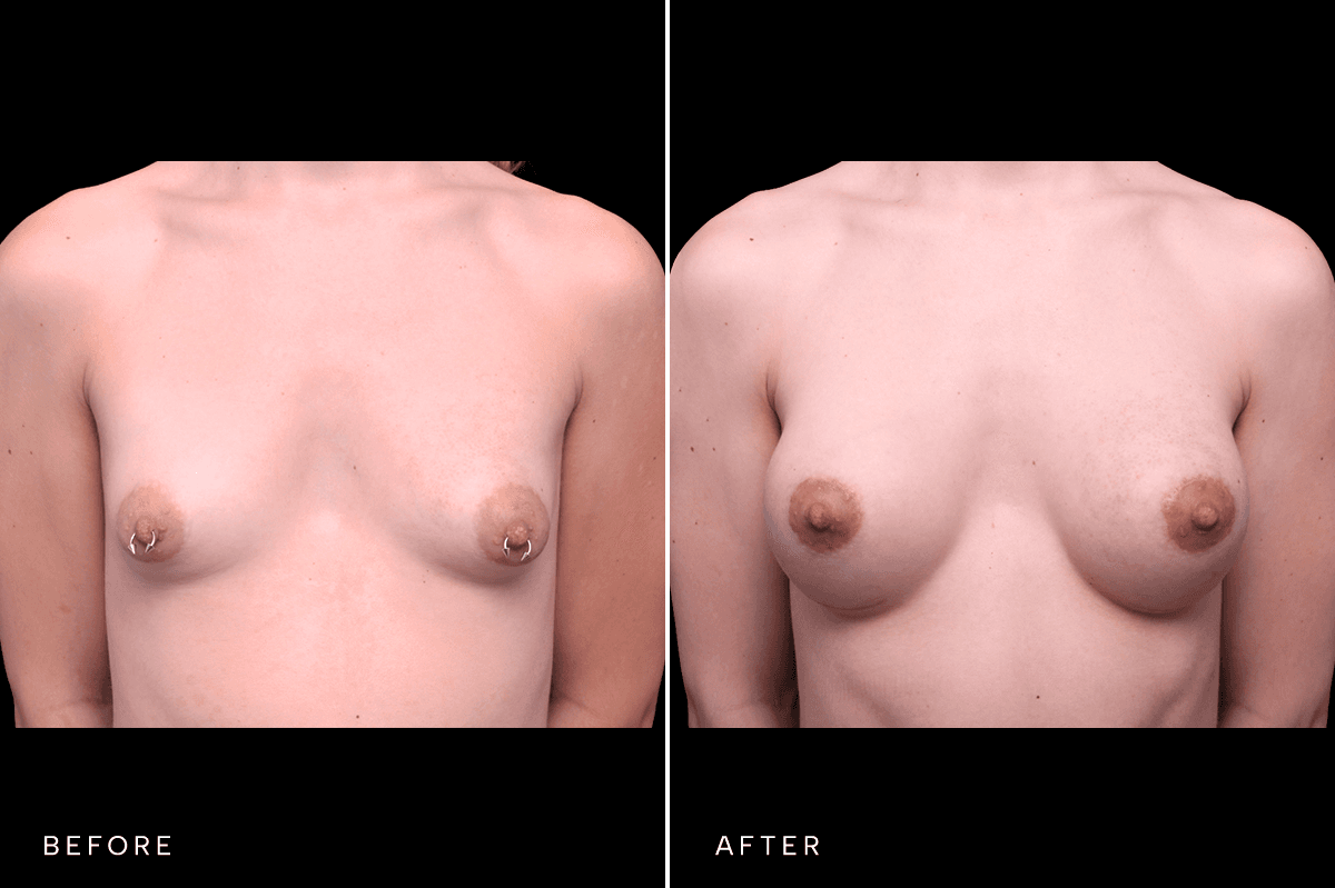 Omni Breast Gallery - BAM GC 5083 - A Front