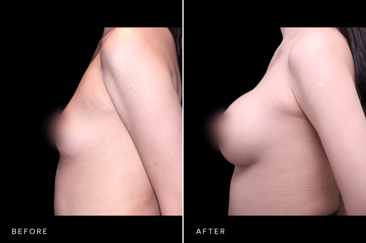 Omni Breast Gallery - BAM 6629 - C Angle