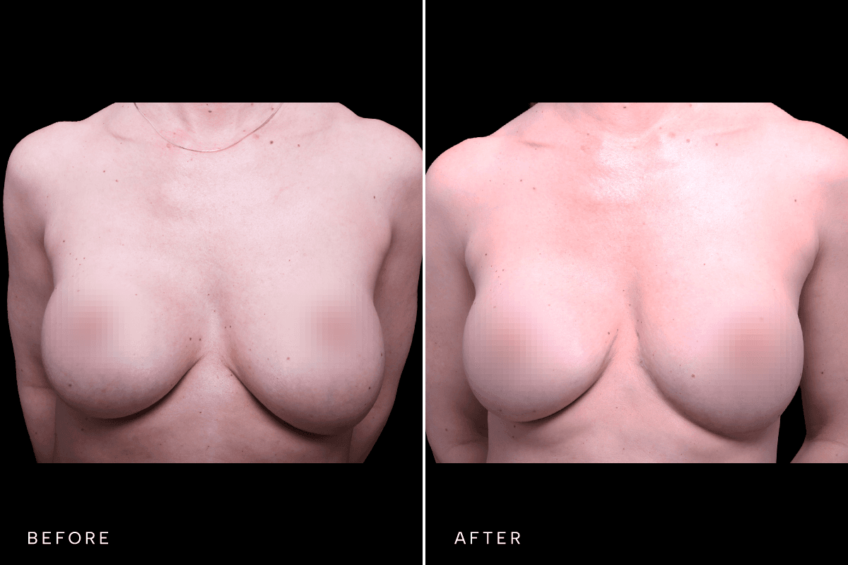 Omni Breast Gallery - MASTO 5977 - A Front