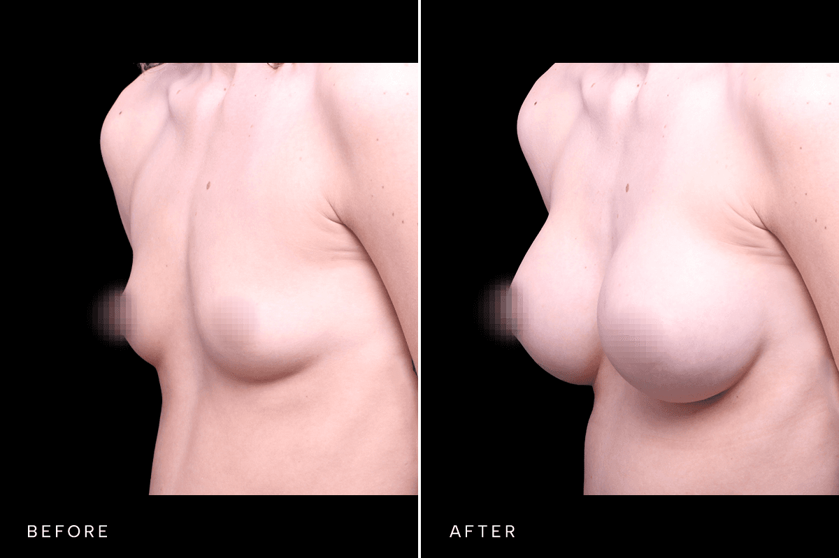 Omni Breast Gallery - BAM 6400 - B Angle