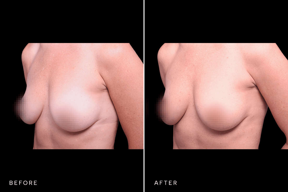 Omni Breast Gallery - FGI 17284 - B Angle