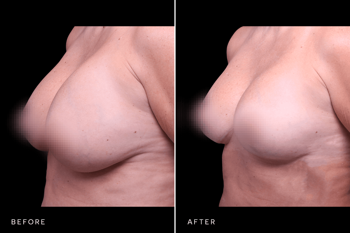 Omni Breast Gallery - MASTO BAM 5933 - C Angle