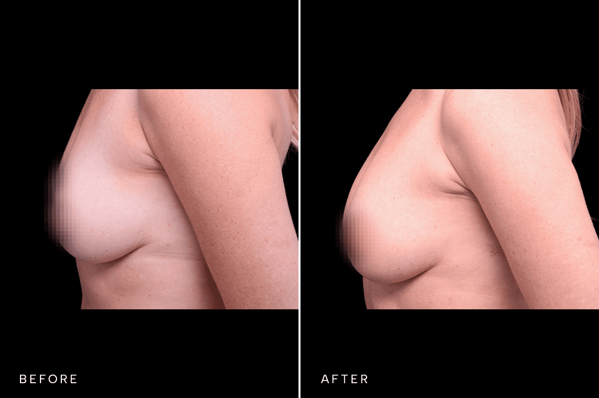 Omni Breast Gallery - FGI 17284 - C Side