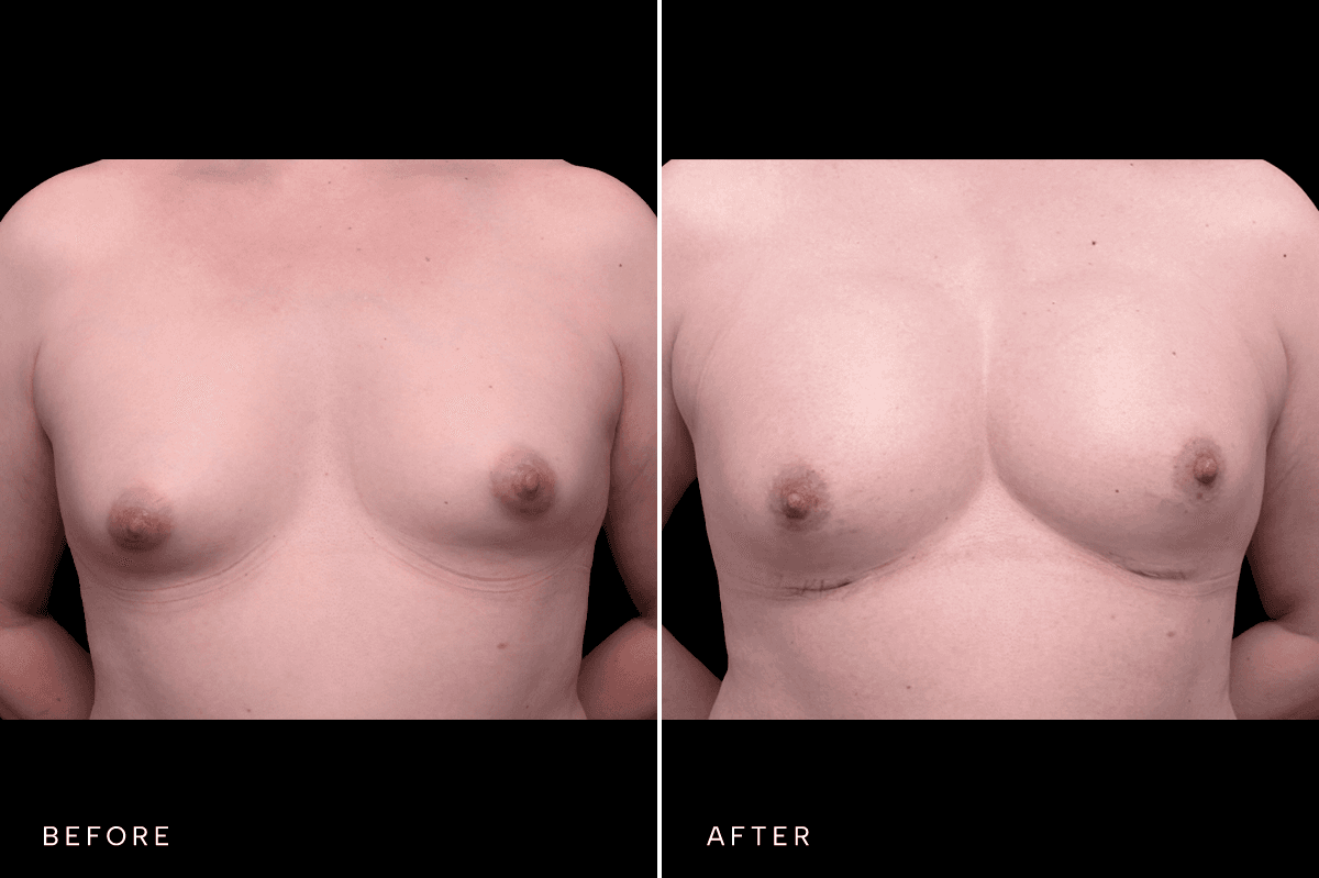 Omni Breast Gallery - BAM GC 6239 - A Front