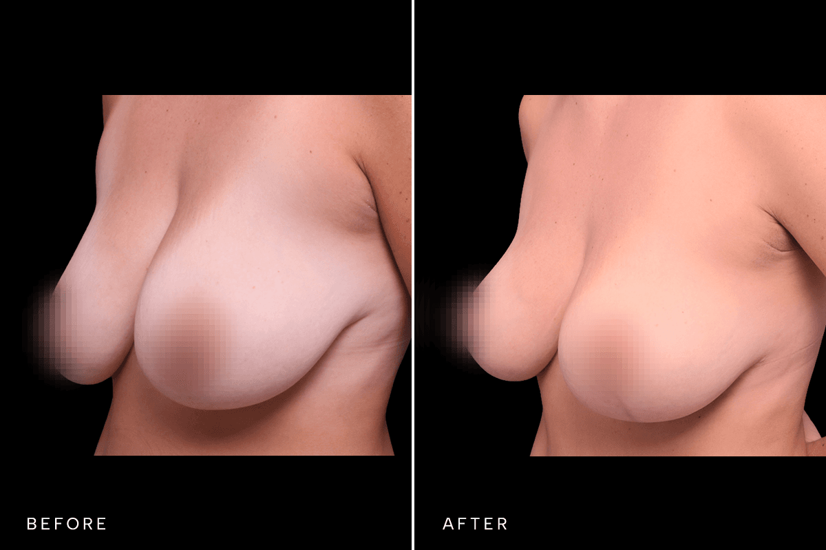 Omni Breast Gallery - Masto 4783 - C Side