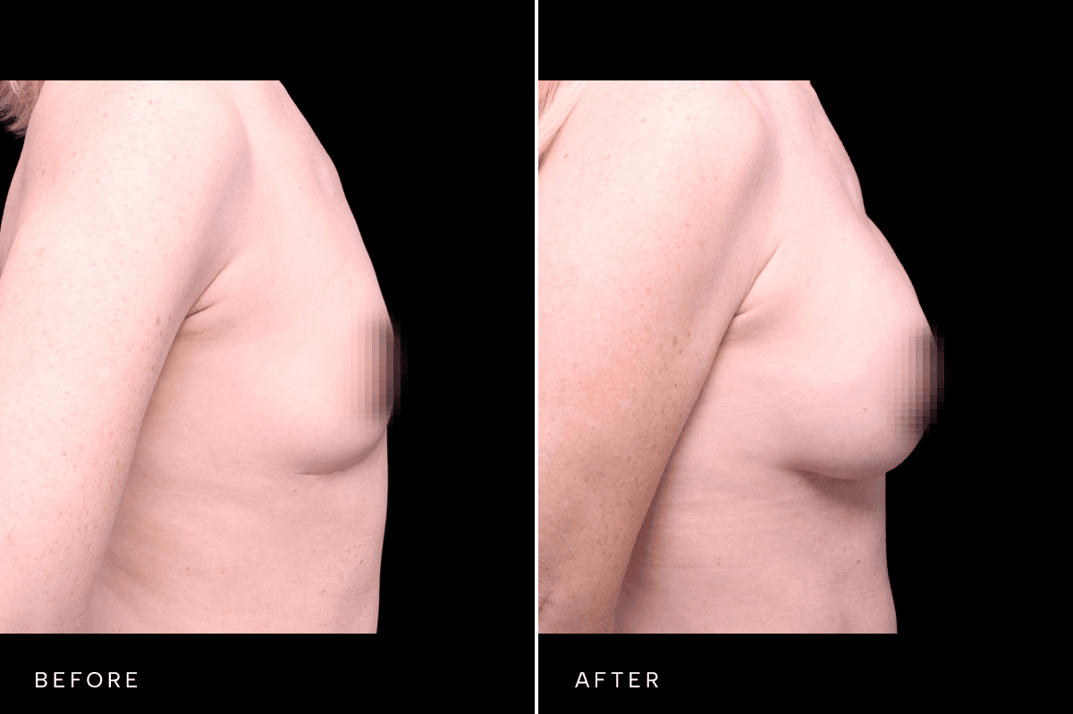 Omni Breast Gallery - BAM 9757 - C Side