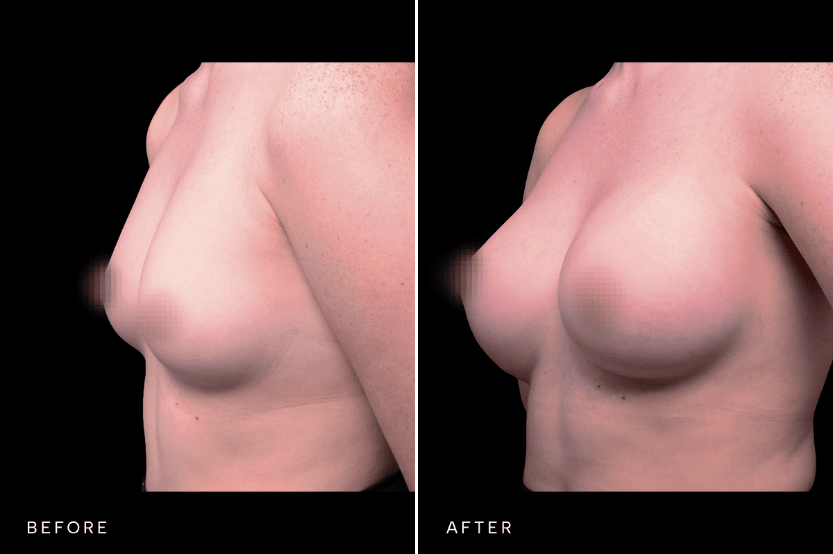 Omni Breast Gallery - BAM 5466 - E Angle