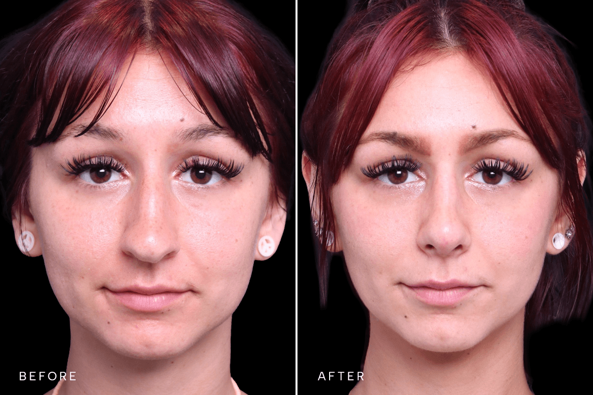 Omni Rhinoplasty Before and After — RHINO 6350 - A Front