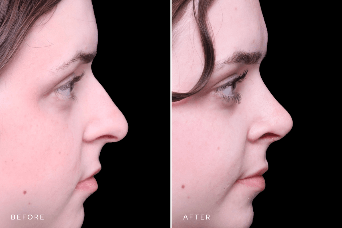 Omni Rhinoplasty Before and After — RHINO 5553 - B Side
