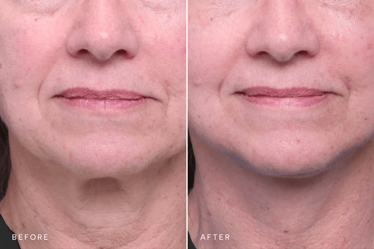 Omni Face Gallery - DP FACELIFT 5527 - A Front