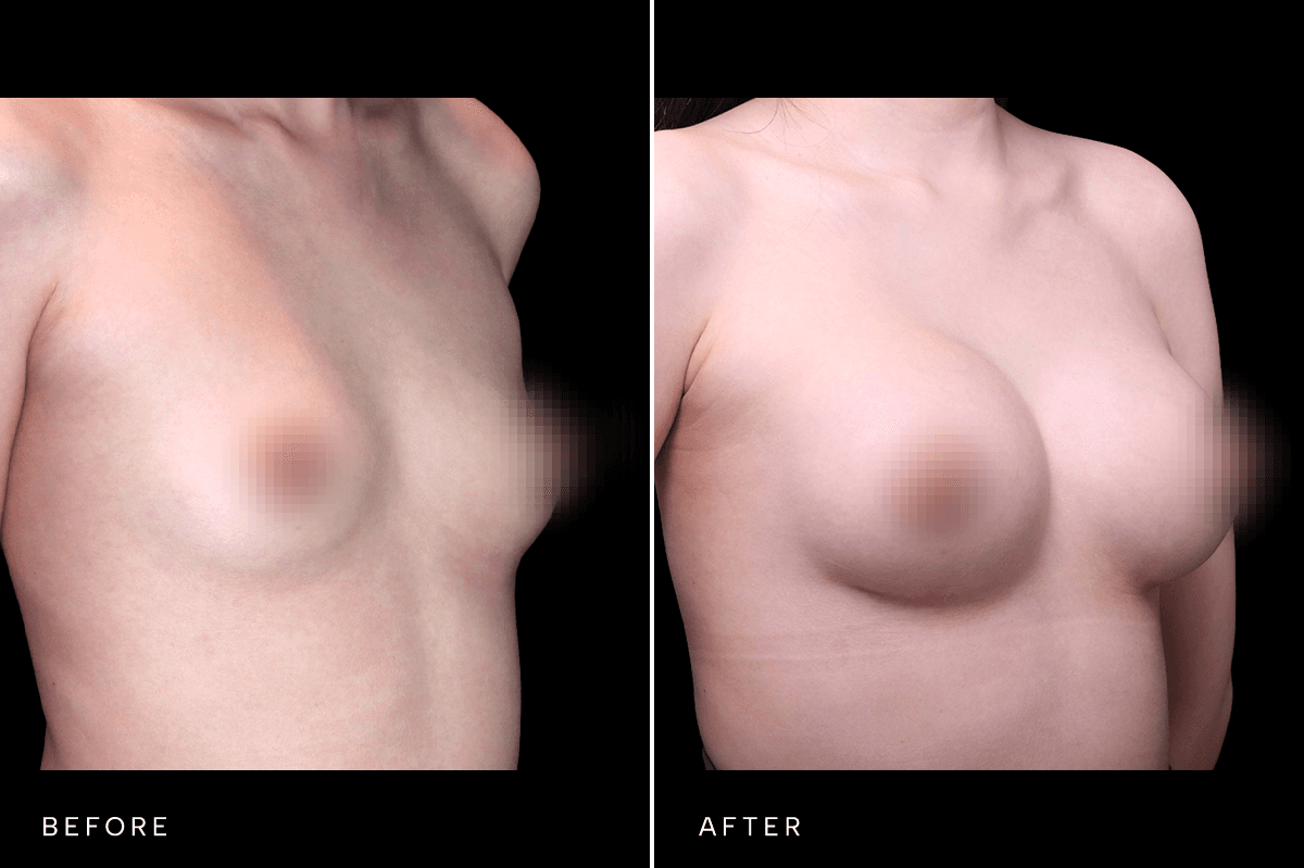 Omni Breast Gallery - BAM 6629 - D Angle
