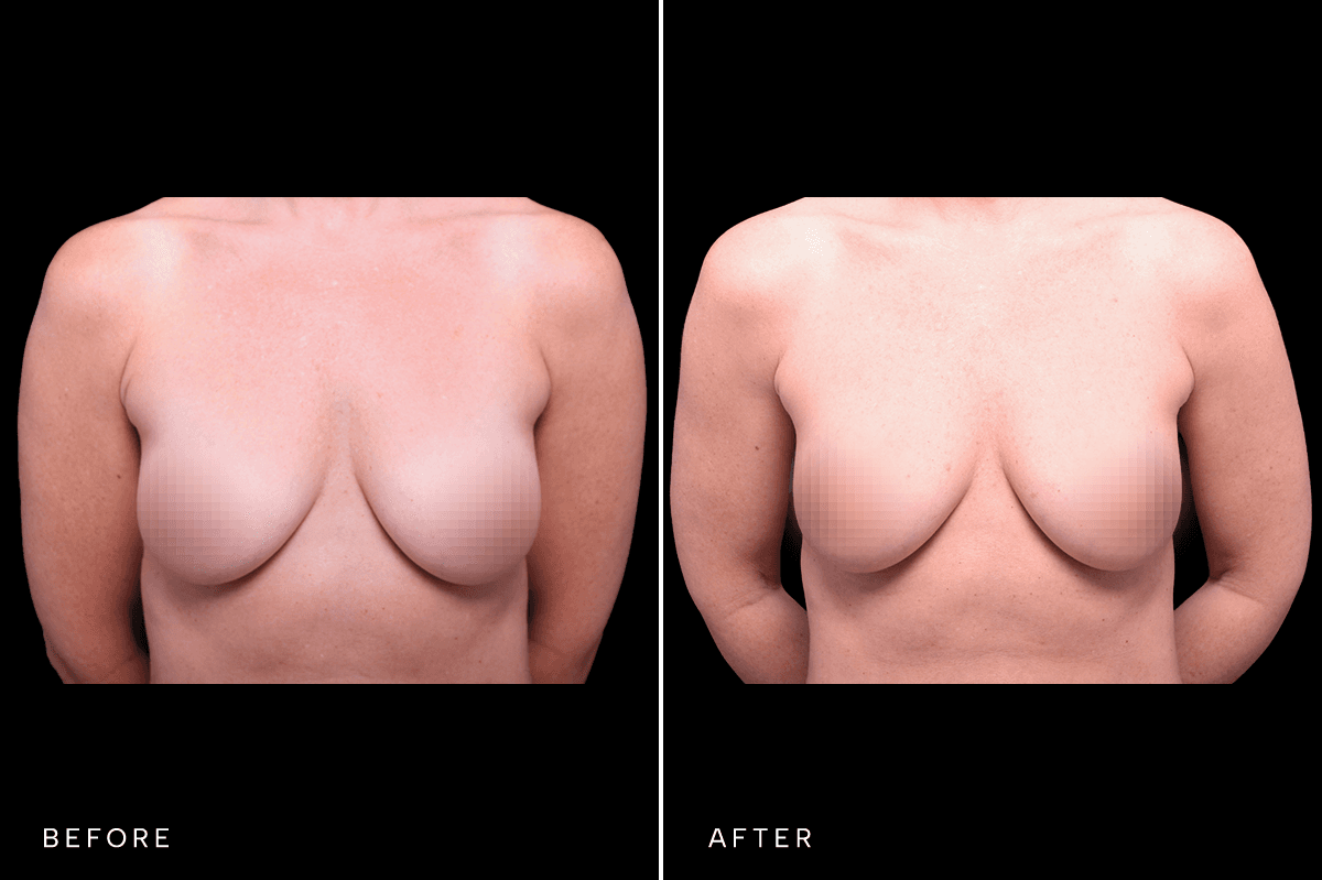 Omni Breast Gallery - FGI 17284 - A Front