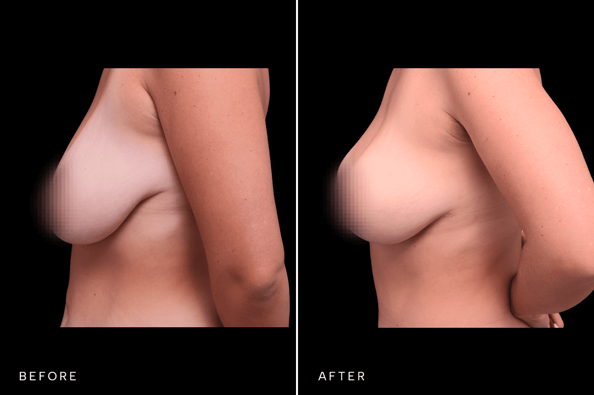 Omni Breast Gallery - Masto 4783 - B Angle