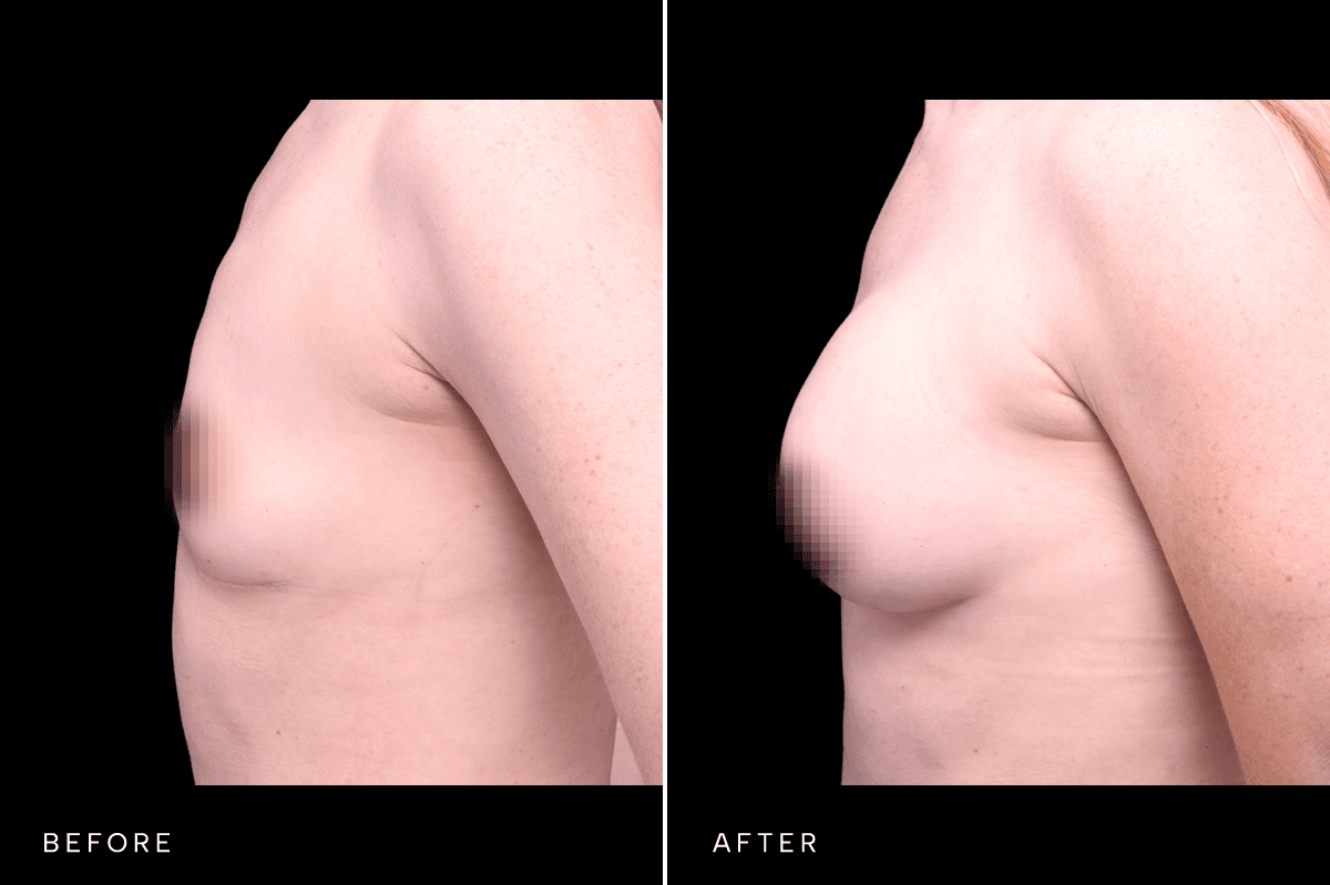 Omni Breast Gallery - BAM 9757 - B Side