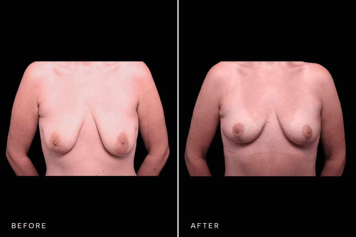 Omni Breast Gallery - Masto 0340 - A Front