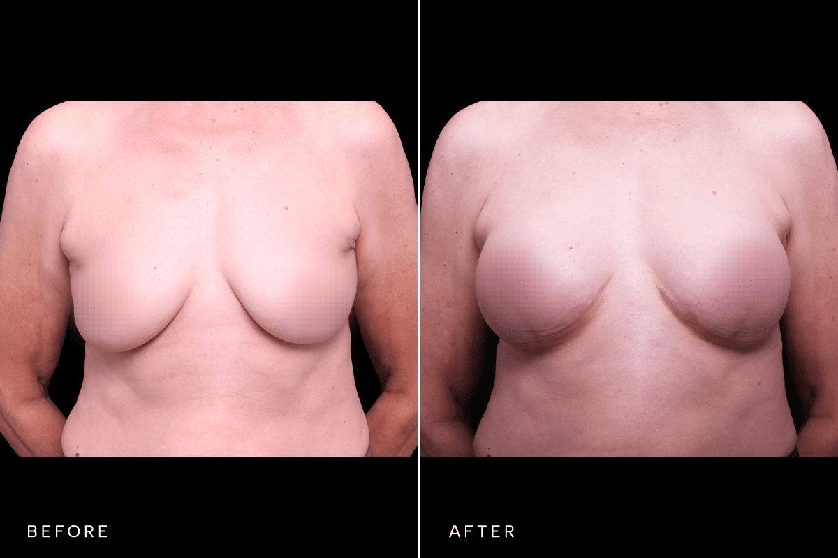 Omni Breast Gallery - MASTO BAM 5527 - A Front