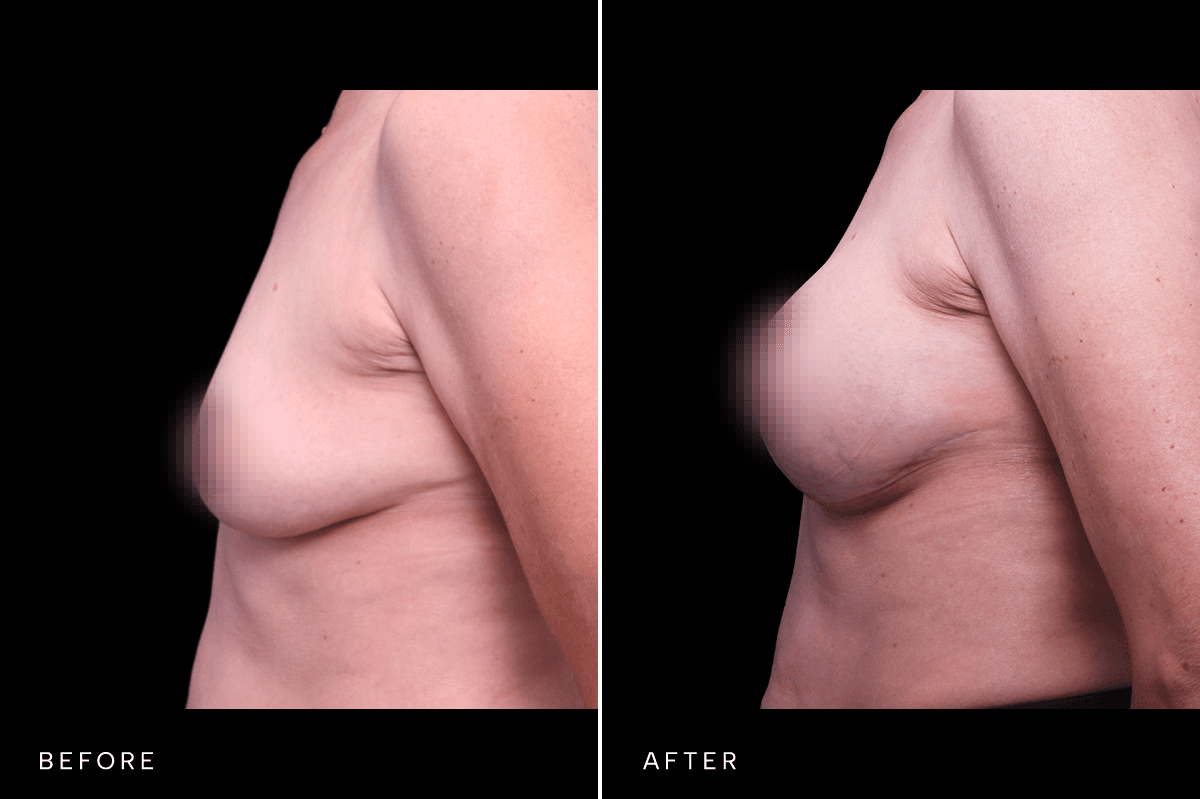 Omni Breast Gallery - MASTO BAM 5527 - C Angle