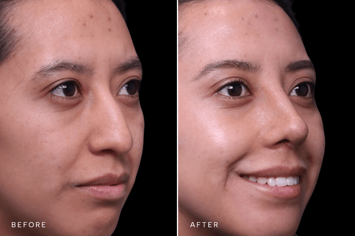 Omni Rhinoplasty Before and After — RHINO 5907 - C Angle