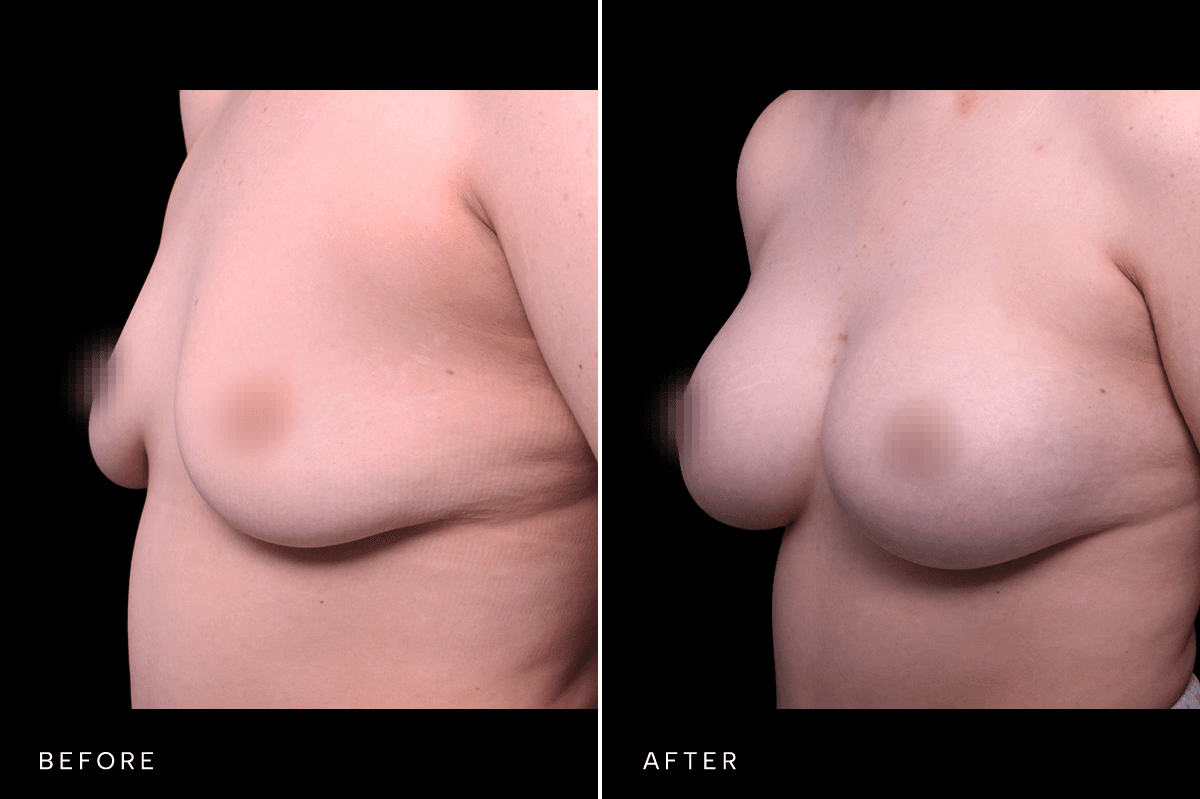 Omni Breast Gallery - BAM 6167 - D Angle