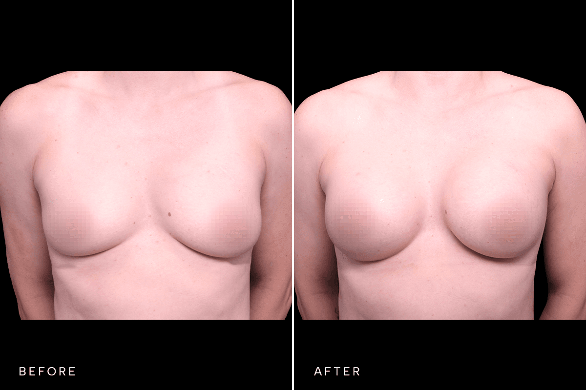 Omni Breast Gallery - BAM 6305 - A Front