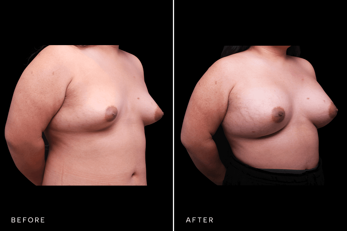 Omni Breast Gallery - BAM 4555 GC - C Angle