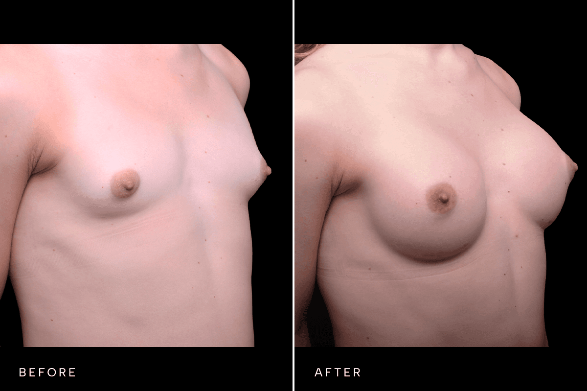 Omni Breast Gallery - BAM GC 4902 - D Angle