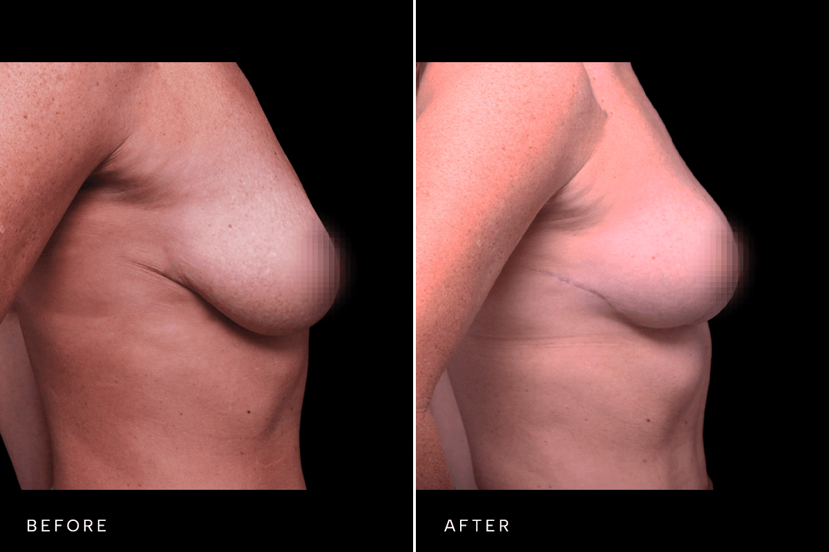 Omni Breast Gallery - MASTO FGI 6034 - B Side