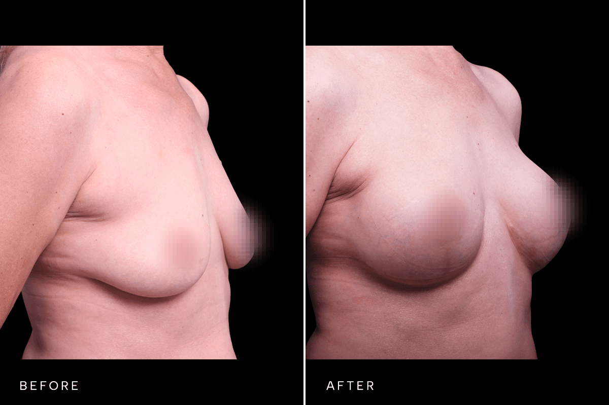 Omni Breast Gallery - MASTO BAM 5527 - B Side