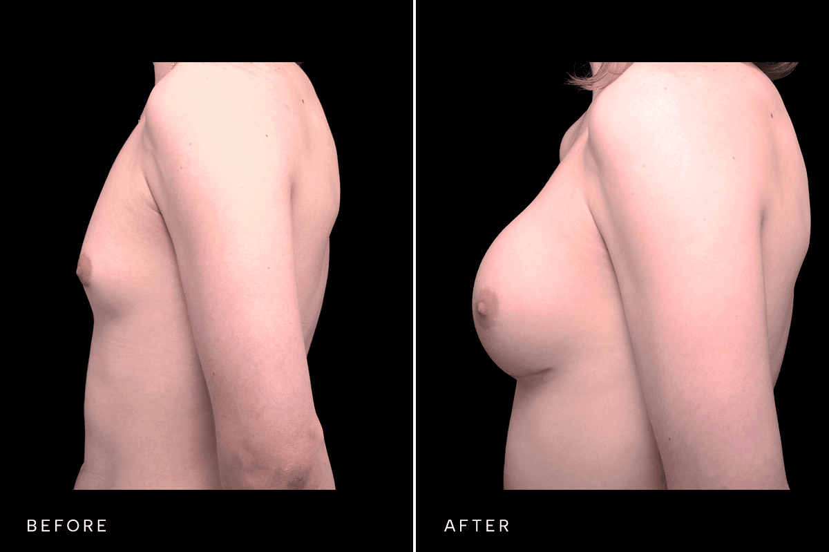 Omni Breast Gallery - BAM GC 4855 - C Side