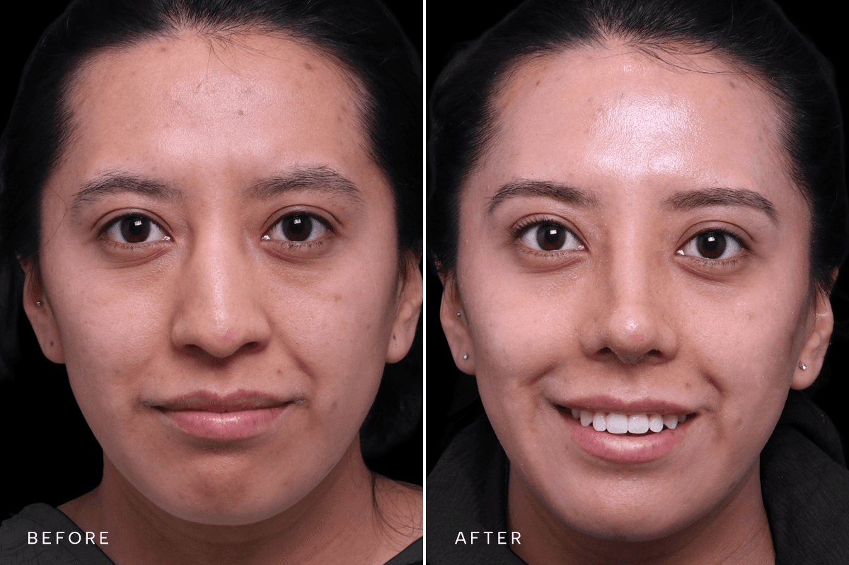 Omni Rhinoplasty Before and After — RHINO 5907 - A Front