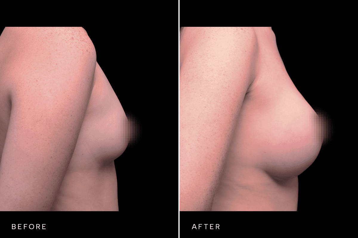 Omni Breast Gallery - BAM 5466 - B Side