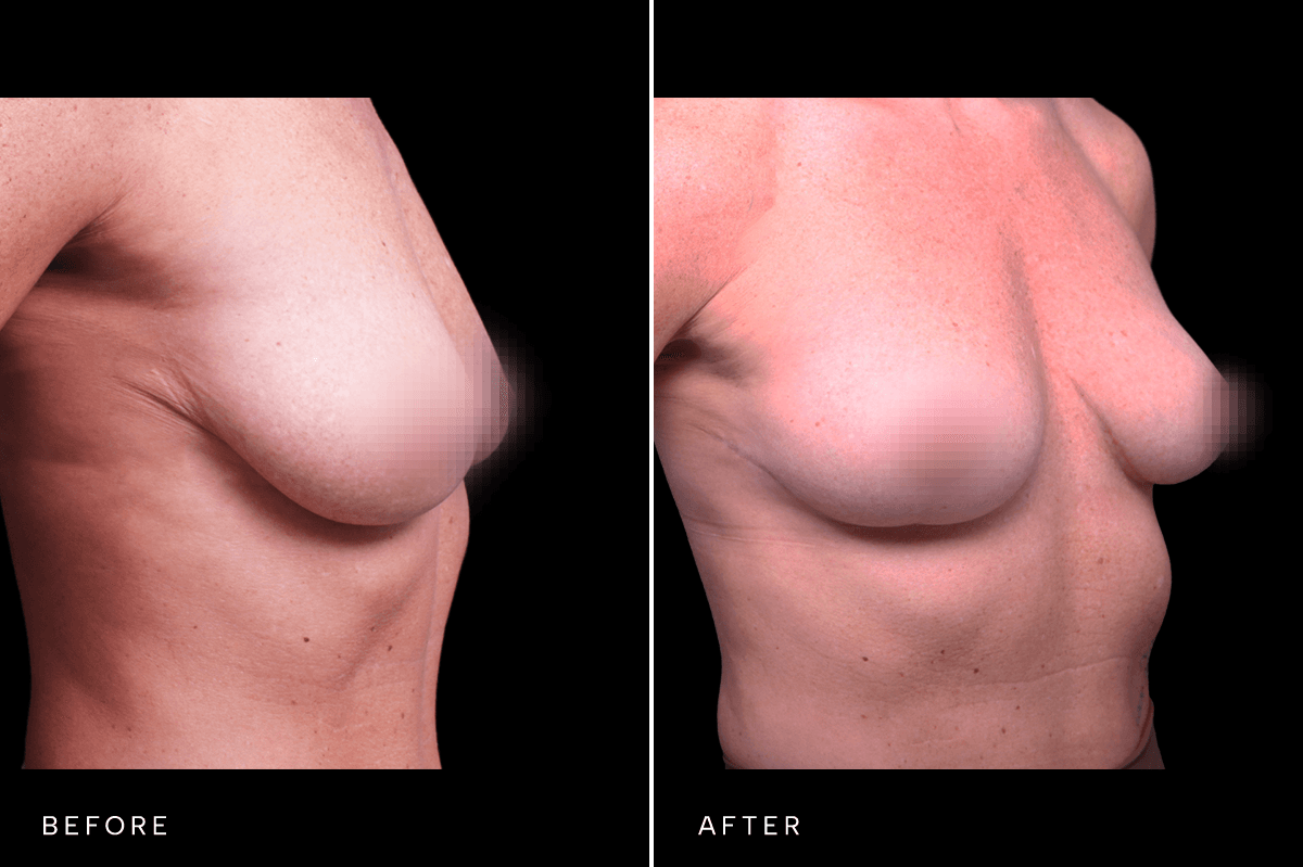 Omni Breast Gallery - MASTO FGI 6034 - D Angle