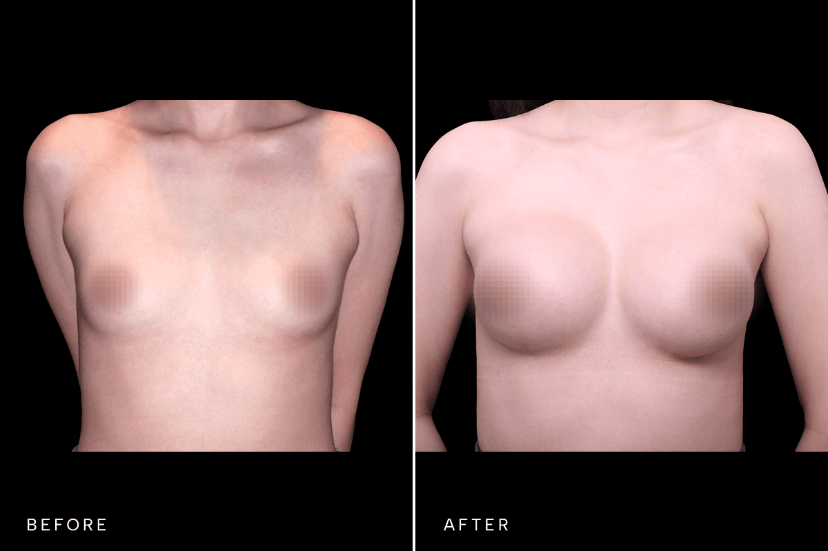 Omni Breast Gallery - BAM 6629 - A Front