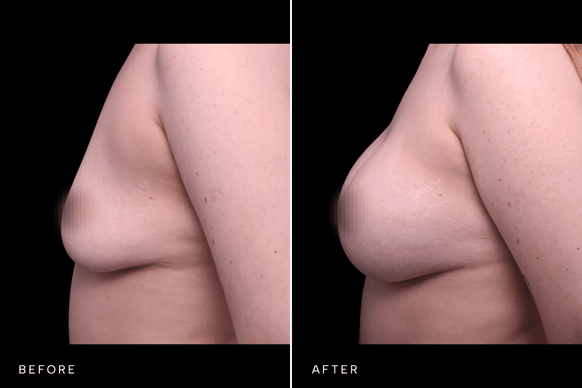 Omni Breast Gallery - BAM 6167 - C Side