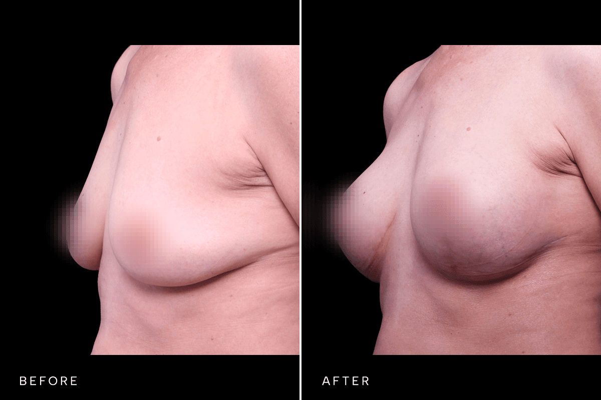 Omni Breast Gallery - MASTO BAM 5527 - D Angle