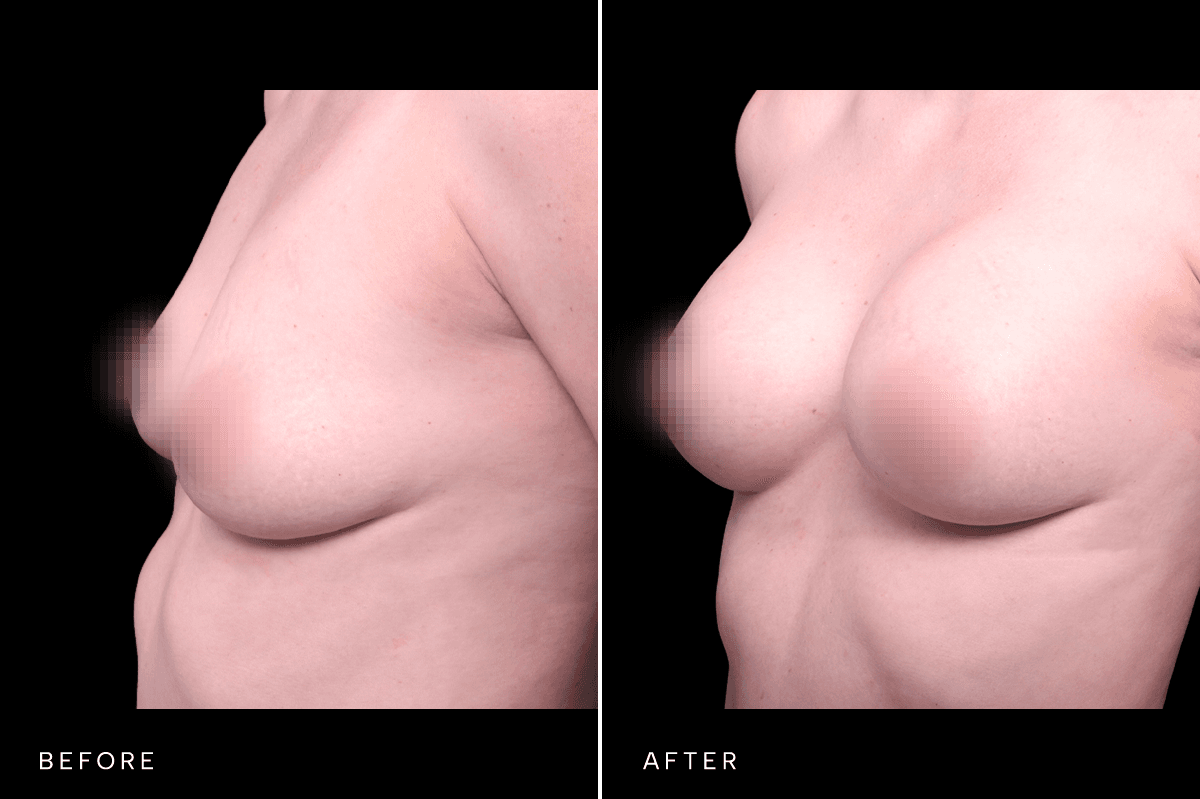 Omni Breast Gallery - BAM 6305 - D Angle