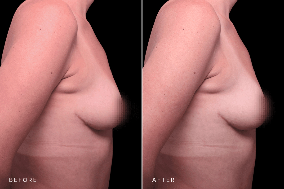 Omni Breast Gallery - Masto 0340 - E Side