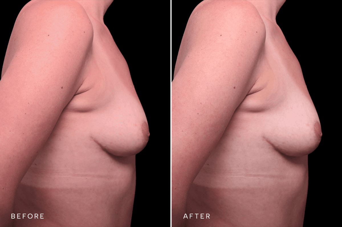 Omni Breast Gallery - Masto 0340 - E Side